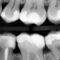 Radiografia digitală bitewing