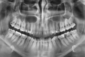 Radiografie digitală panoramică