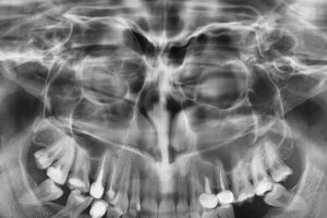 Radiografie digitală panoramică sinusuri