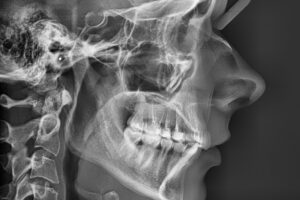 Radiografie- teleradiografie digitală de profil