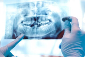 radiografie-dentara